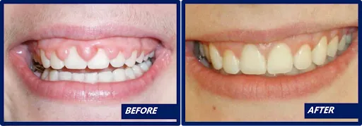 periodontal treatments 2