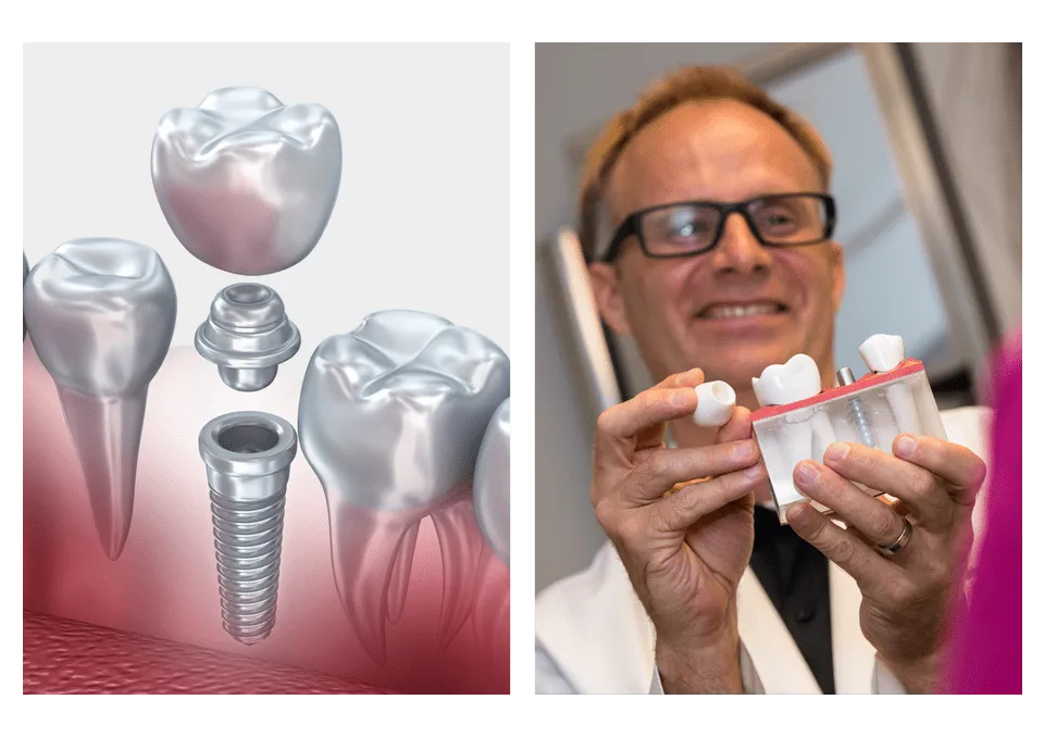 dr bingham holding dental implants model 1