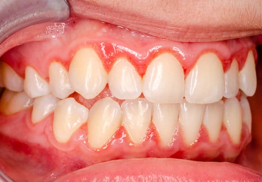 fresh breath starts with healthy gums
