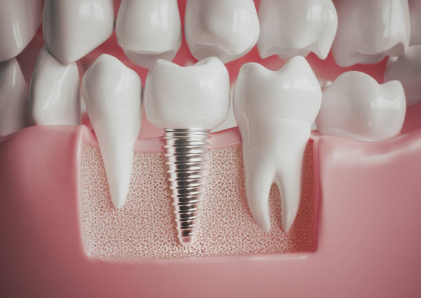 Cross-section image of a dental implant replacing a missing tooth, showing the titanium post secured in the jawbone for tooth restoration in Austin, Texas