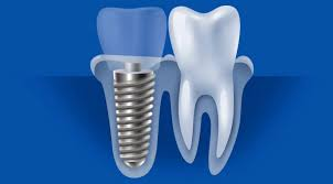 Illustration comparing a dental implant to a natural tooth, showing implant components and structure used at Council Oak Perio in Austin, Texas