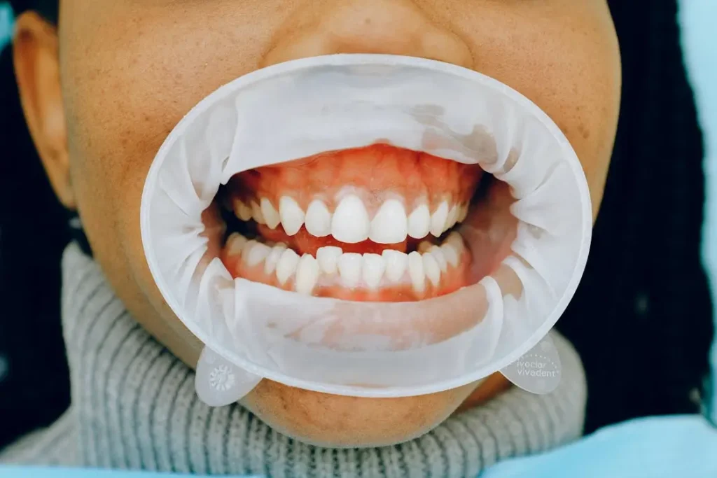 gum recession