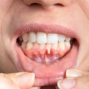 gum recession
