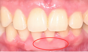 gum graft 1a 1