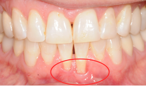 gum graft 1b 0
