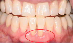 gum graft 1b 1