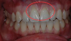 gum graft 1c 0