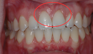 gum graft 1c 1