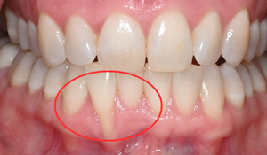 gum graft 1d 0