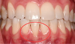 gum graft 1e 2
