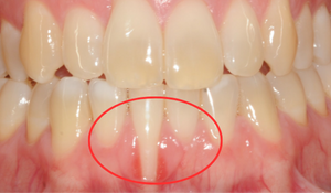 gum graft 1f 0
