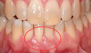 gum graft 1f 1