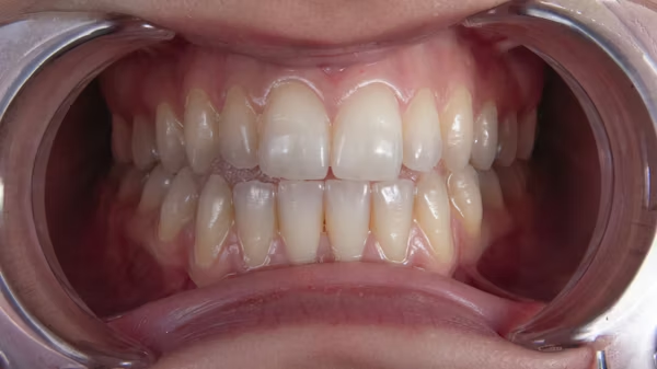 close-up shot of teeth with the use of mouth prop