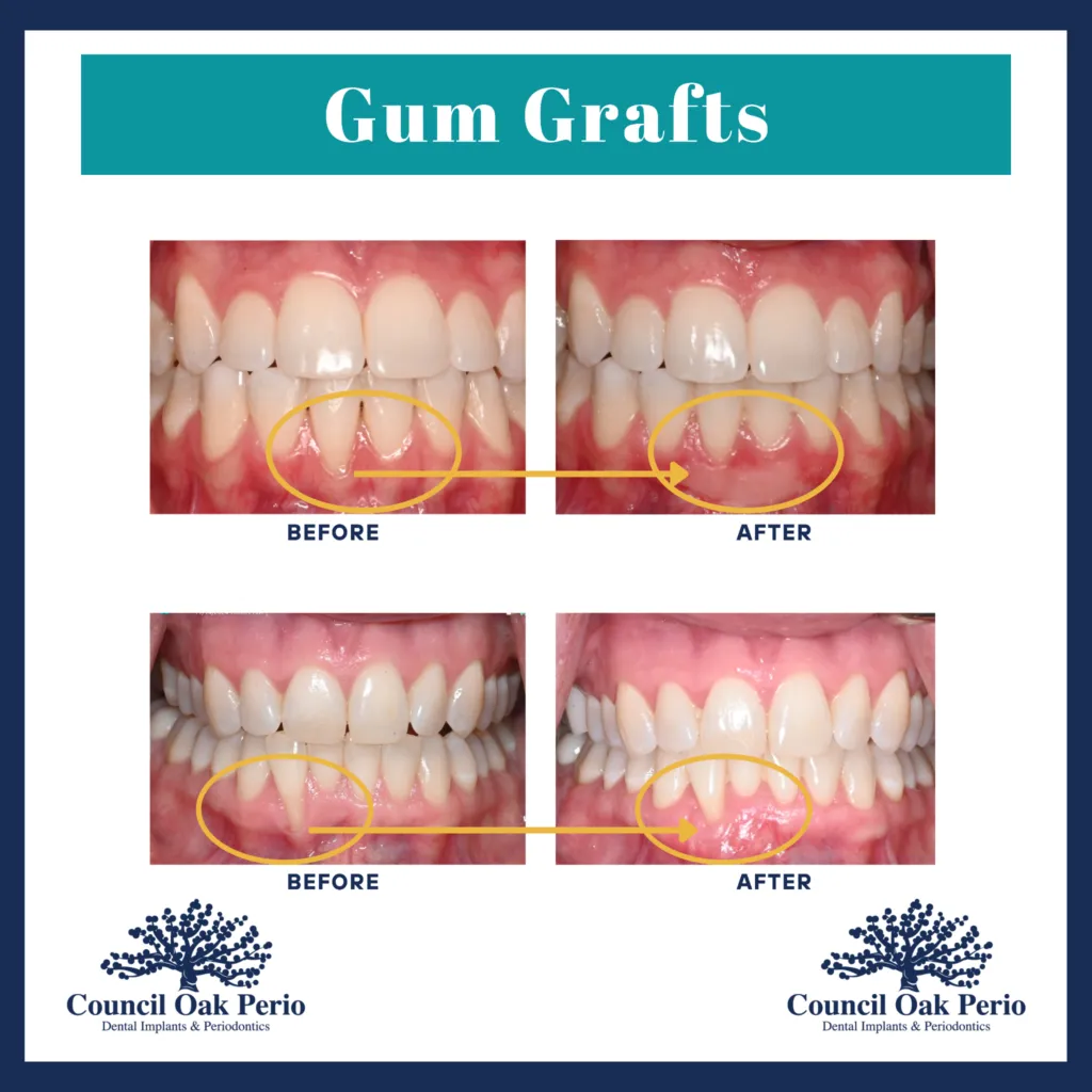 Gum recession treatment before and after results at Council Oak Perio in Austin, TX