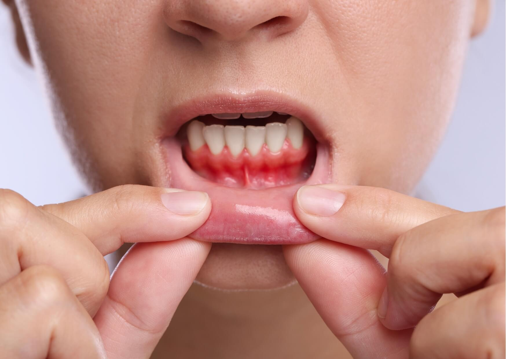Close-up of receding gums exposing the lower tooth roots, illustrating visible signs of gum recession.