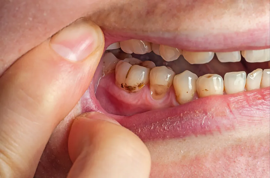 Cavity at the gum line caused by gum recession, evaluated at Council Oak Perio in Austin, TX