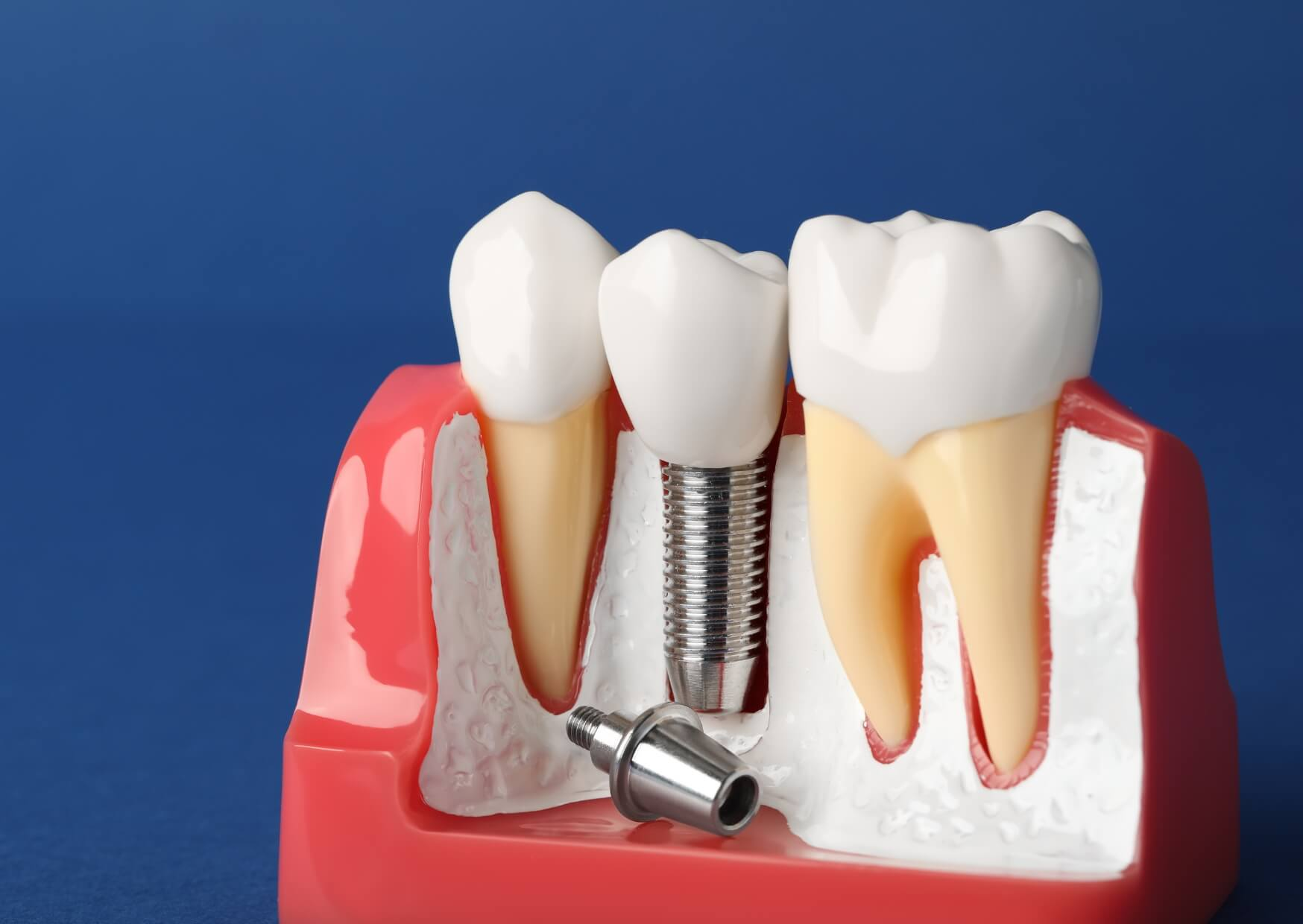 Dental implant model displaying the implant post, abutment, and crown to explain the components that influence dental implant costs.