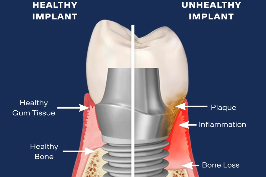 Diagram of a dental implant showing signs of peri-implantitis at Council Oak Perio in Austin, TX