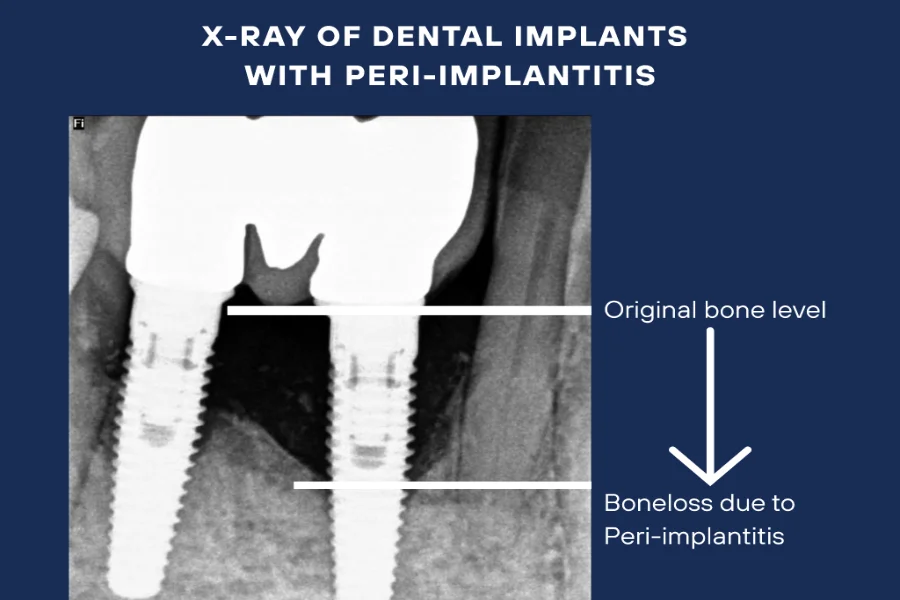 X-ray showing bone loss around a dental implant with peri-implantitis, Council Oak Perio in Austin, TX