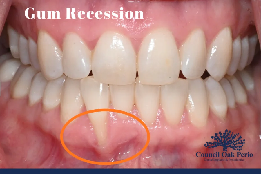 Gum recession with exposed tooth roots evaluated at Council Oak Perio in Austin, TX