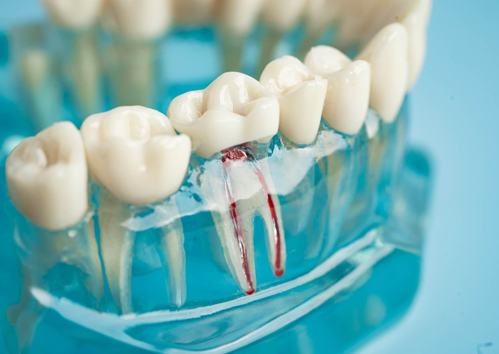 Dental model showing exposed tooth roots caused by gum recession, illustrating how roots become visible when gum tissue pulls away.