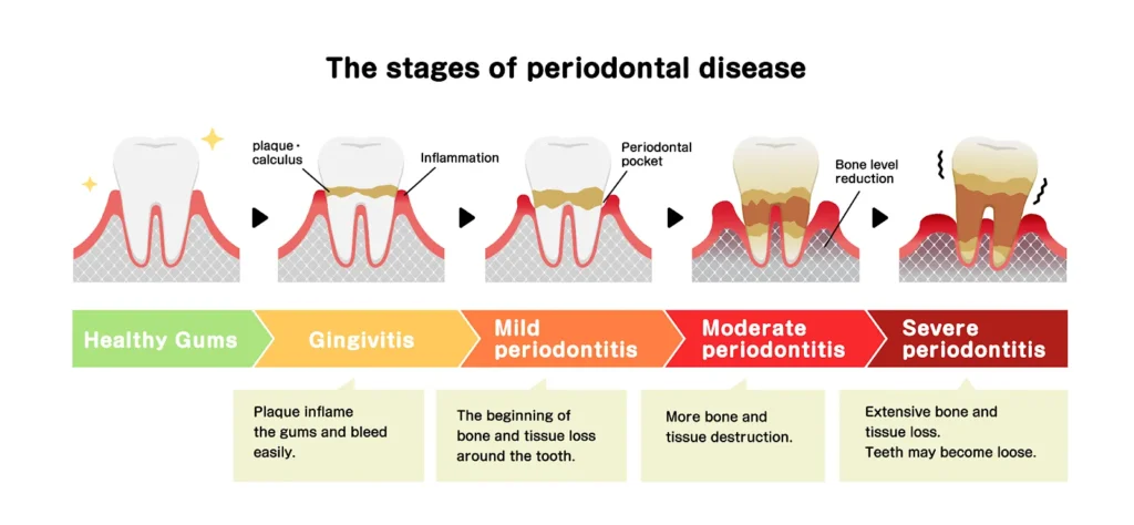 stages of periodontal disease diagram
